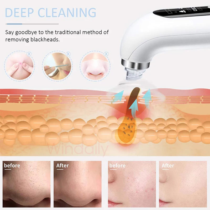 Blackhead Pore Vacuum Cleaner